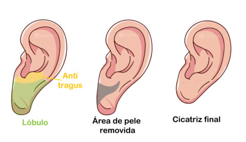 Rejuvenescimento De L Bulo De Orelha