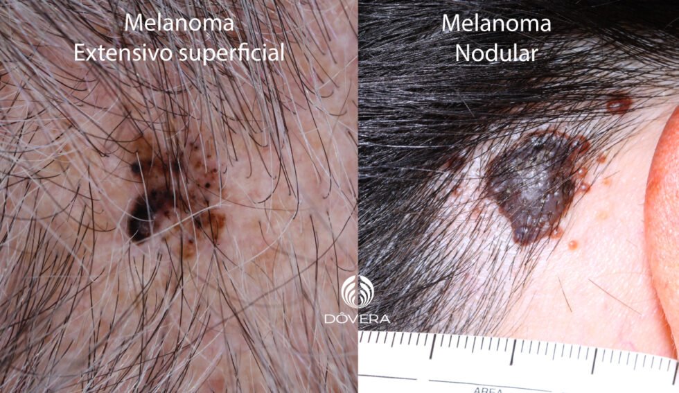 Melanoma De Couro Cabeludo Diagn Stico E Tratamento