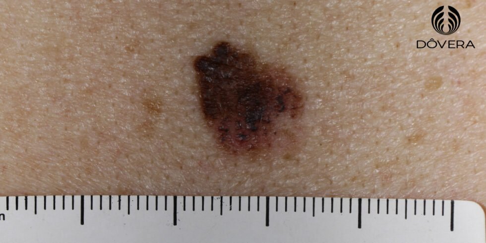 Melanoma Extensivo Superficial Diagnóstico E Tratamento