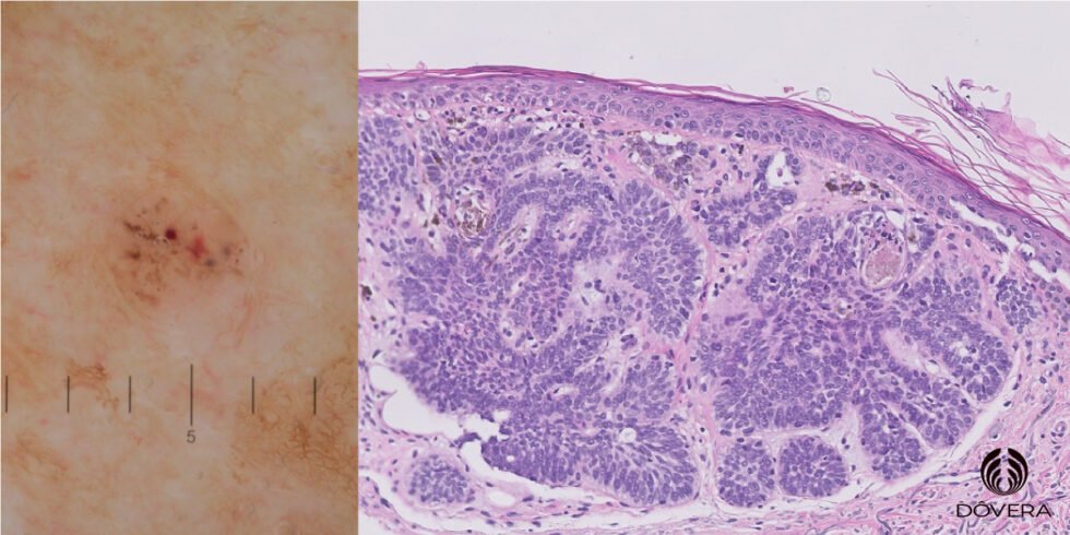 Como Interpretar O Resultado Da Biópsia De Um Carcinoma Basocelular 